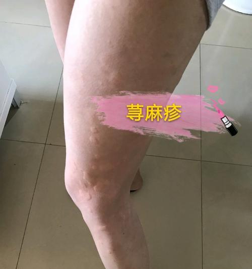 狗所引发的荨麻疹的原因与治疗方法（探究狗引发荨麻疹的原因以及如何有效治疗）