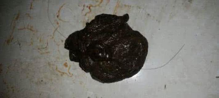 拉黑色大便的原因解析（了解黑色大便的成因及其健康隐患）