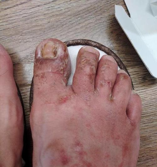 为什么狗会得甲沟炎？（探寻导致狗得甲沟炎的原因和预防方法）