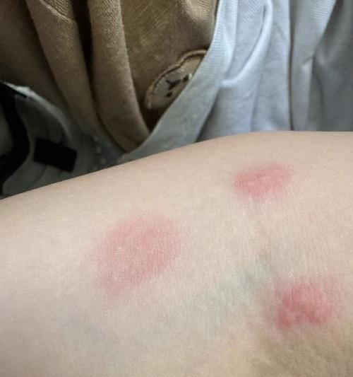 腹部红点是什么病？（了解腹部红点的原因及应对方法）