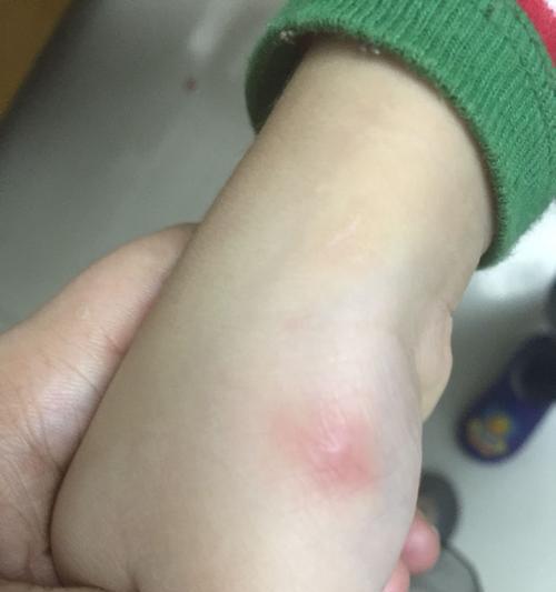 了解弓形虫检查的重要性——预防症状及筛查方法（弓形虫检查，提前发现潜在威胁）