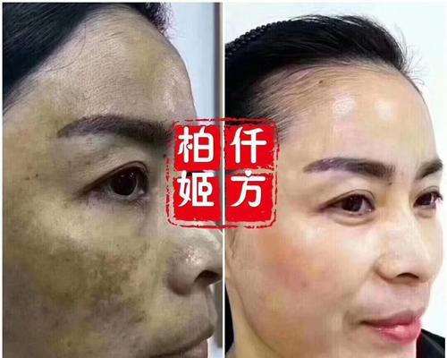 泰迪长螨虫后多久能好？（探索泰迪治疗长螨虫的时间线）