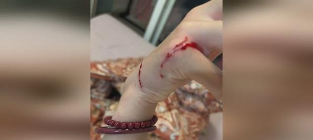 猫咬伤后的症状及持续时间分析（探究猫咬伤后症状的持续时间和预防措施）